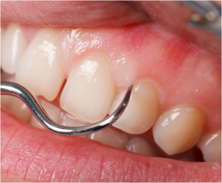 歯石・プラークの除去